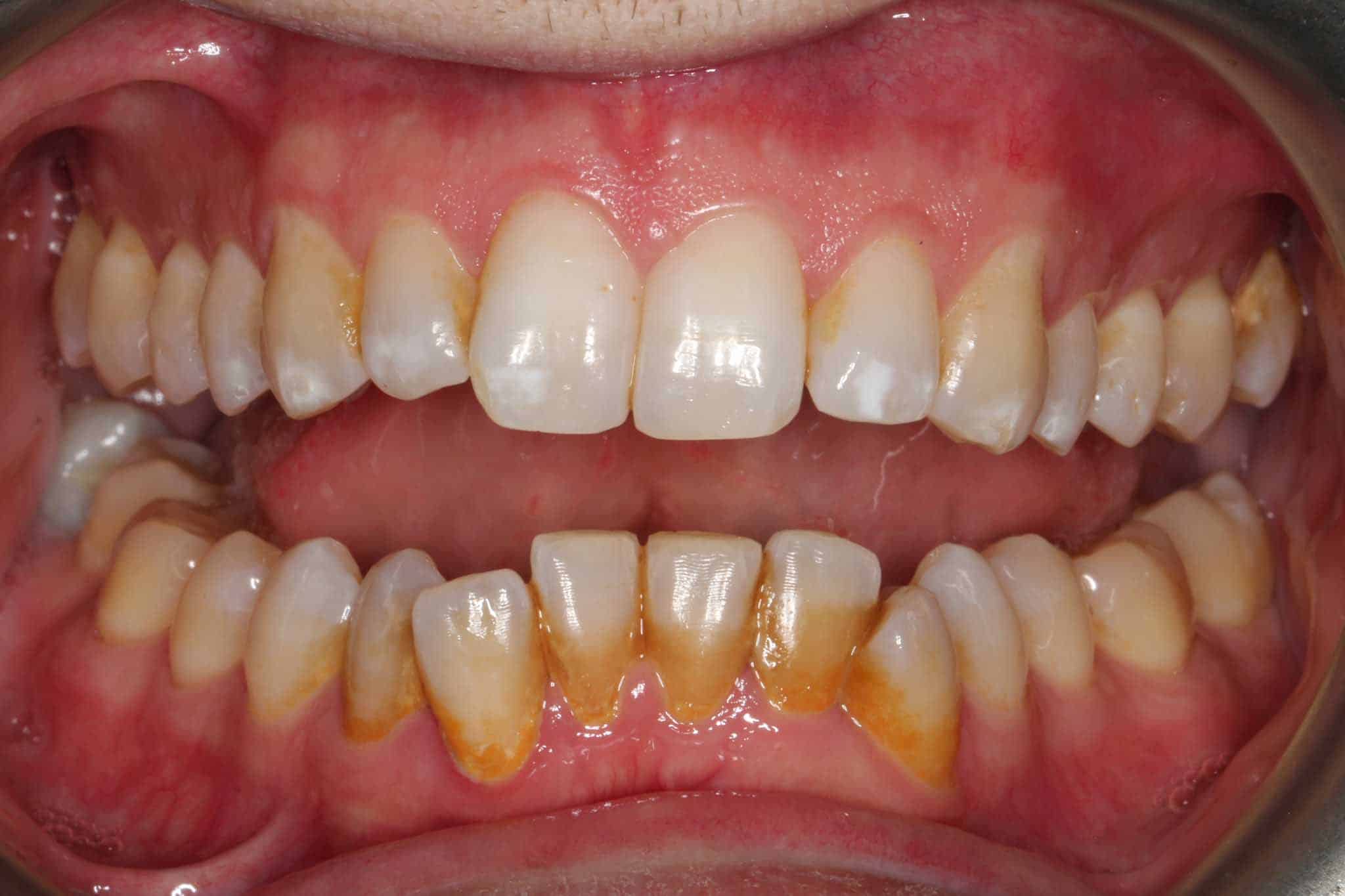 Før- og etterbilde: Hos Kolbotn Tannklinikk fjernet tannlegene belegg og misfarging – pasient fra Kolbotn, Follo og Vinterbro.