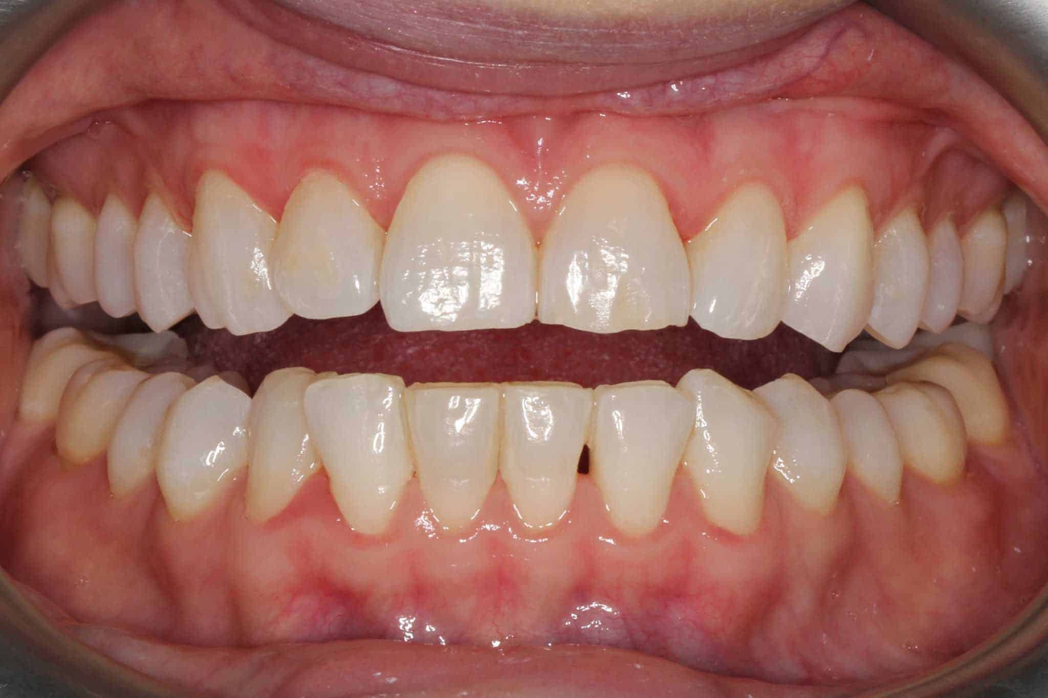 Før- og etterbilde: Hos Kolbotn Tannklinikk fjernes store mengder tannstein – bedre tannhelse i Kolbotn, Nordstrand, Holmlia.