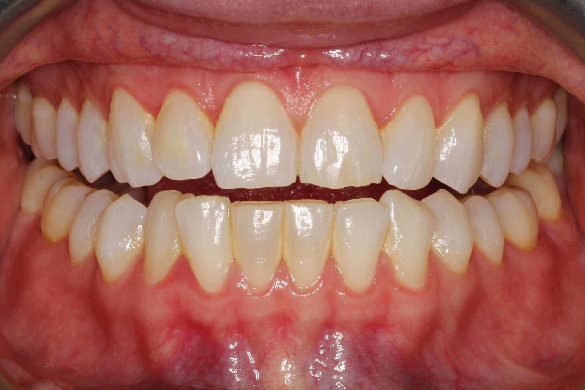 Før- og etterbilde: Tannleger på Kolbotn Tannklinikk fjernet tannstein for friskere smil – Kolbotn, Oppegård, Greverud.