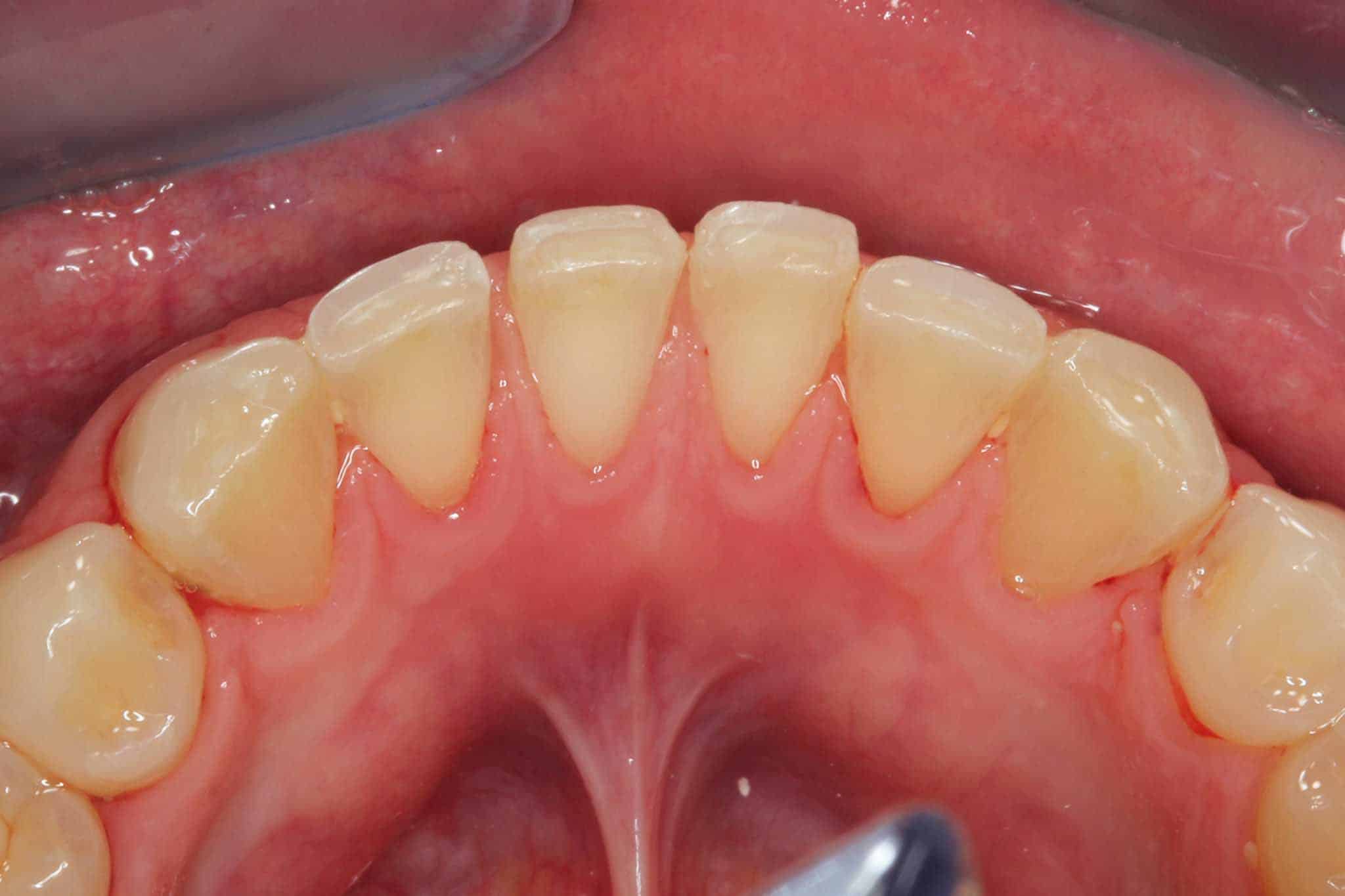Galleri: Hos Kolbotn Tannklinikk fjerner tannleger tannstein på fortenner – Kolbotn, Follo og Myrvoll.